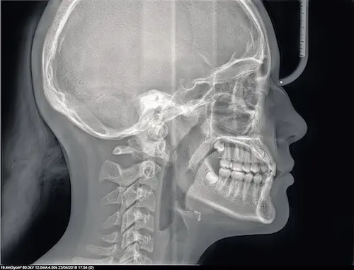 Radiografía sacado en equipos de imágenes dentales