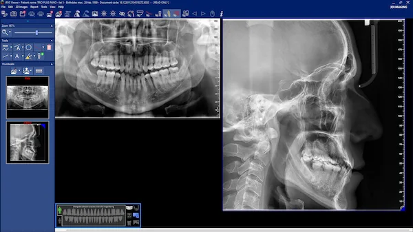 El equipo panorámico dental permite obtener una visión general de la estructura de ósea