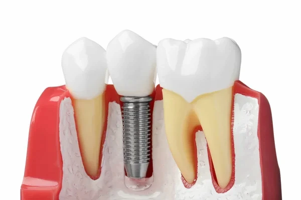 Practicas de rehabilitación oral: Dientes postizos