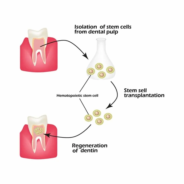 Gráfico que demuestra el uso de la odontología regenerativa mediante células madre