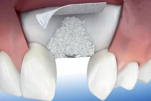 Medicina regenerativa en odontología El futuro de los tratamientos dentales
