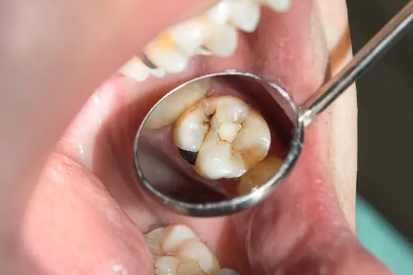 Consejos para prevenir todos los tipos de caries