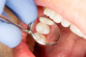 Qué tipos de caries existen y cuál es más común