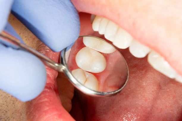 Qué tipos de caries existen y cuál es más común