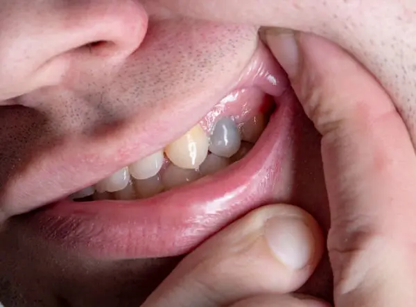 ¿Cuál es el tipo de caries más común en la población