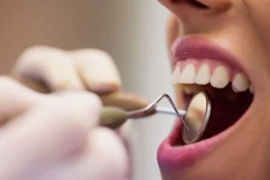 Recesión gingival