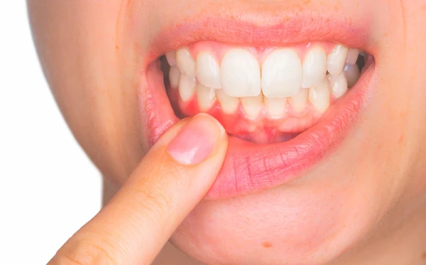 Recesión gingival Causas, prevención y tratamiento